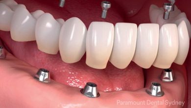 Photo of Everything To Know About Dental Implants In Sydney
