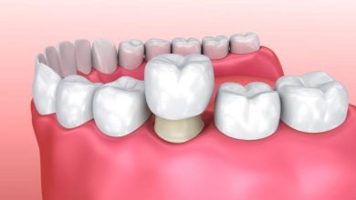 Photo of Dental Crowns: All You Need to Know
